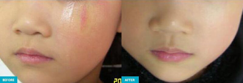 healite ii before and after