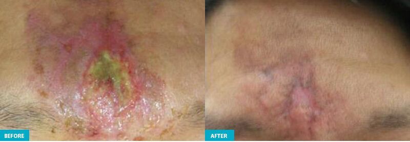 Princeton healite ii before and after face