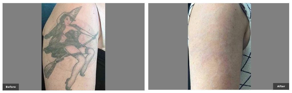 Princeton tattoo removal before and after
