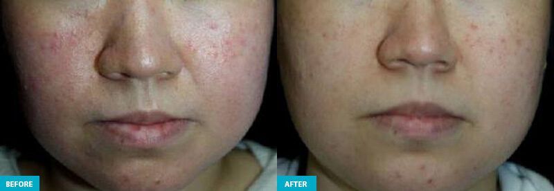 healite ii before and after