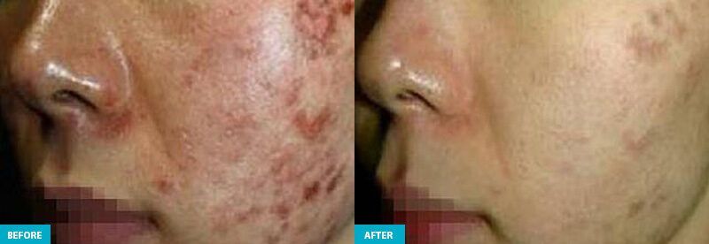 healite ii before and after