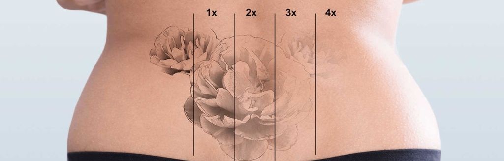 princeton laser tattoo removal before and after