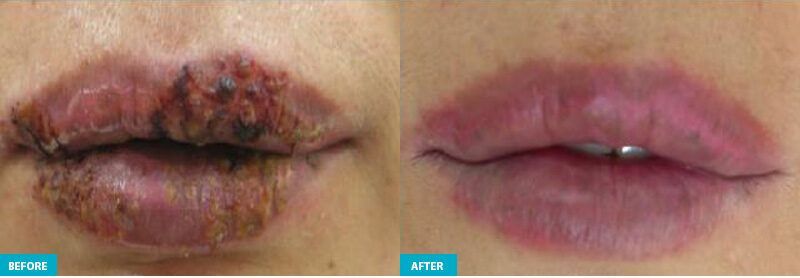 Princeton healite ii before and after lips