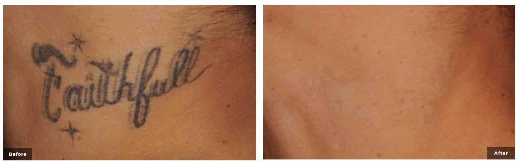 princeton laser tattoo removal before and after