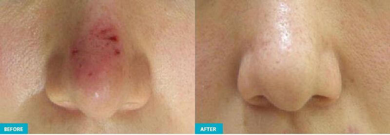 healite ii before and after