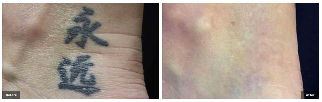 princeton laser tattoo removal before and after