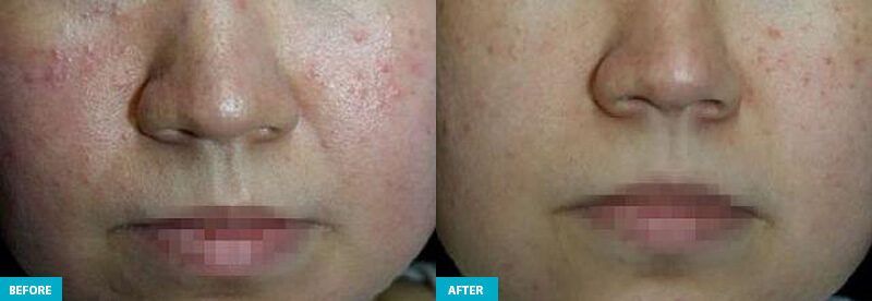 healite ii before and after