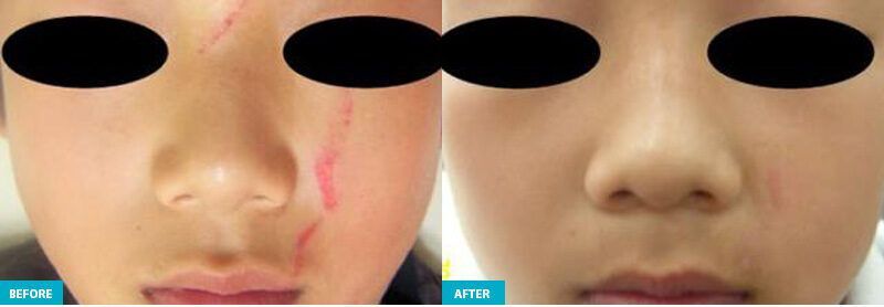 healite ii before and after